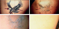 tattoo removal photo long island oyster bay